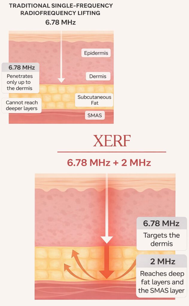 xerf vs other skin tightening devices vert