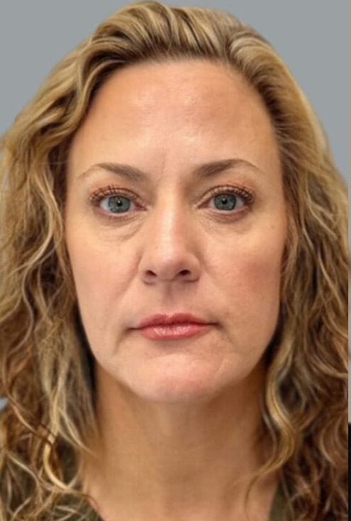 dermal filler after ahwatukee az