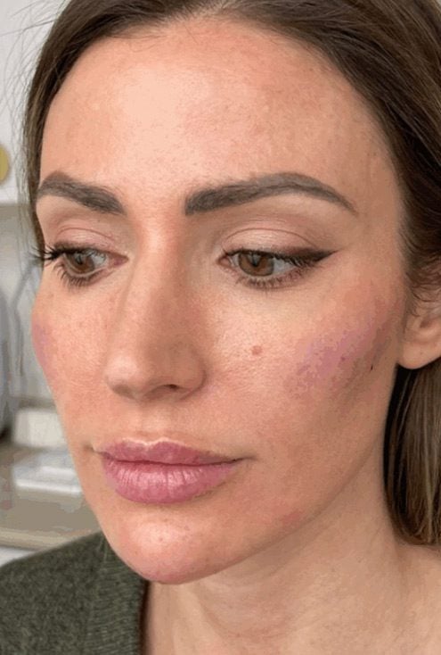 dermal filler cheeks after ahwatukee az
