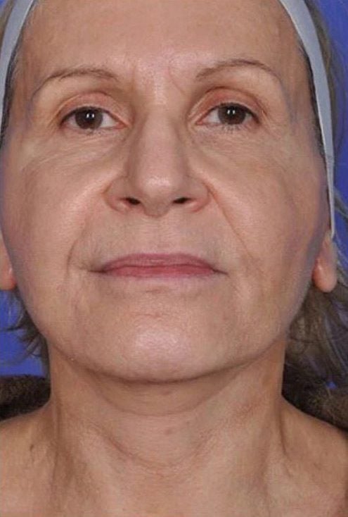 xerf face skin tightening after ahwatukee phoenix az