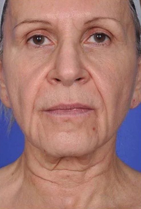 xerf face skin tightening before ahwatukee phoenix az