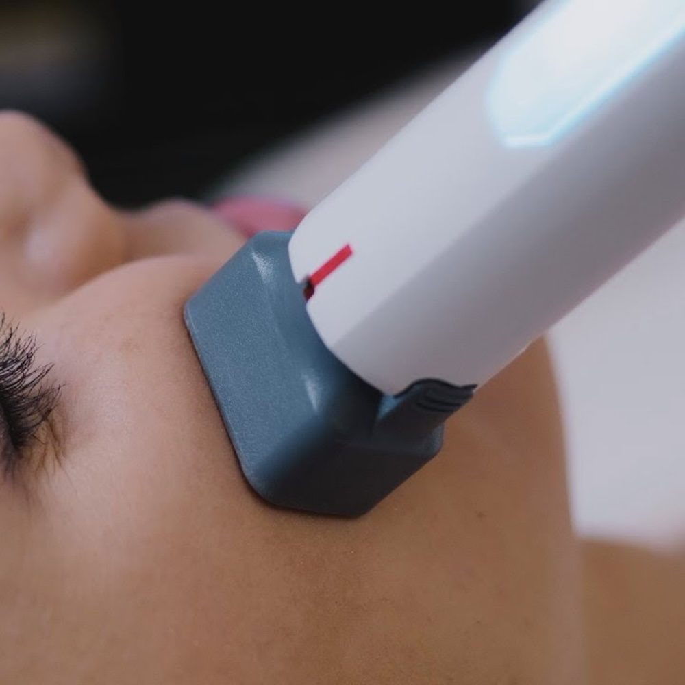 xerf skin tightening in ahwatukee