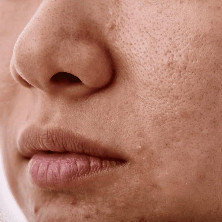Rough Skin Texture treatment in south phoenix az