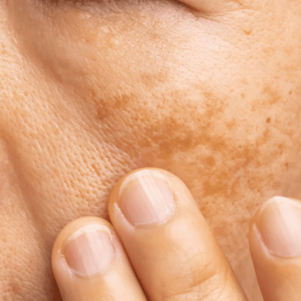 Sun Damage & Pigmentation in south phoenix az