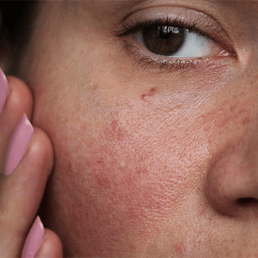 Uneven Skin Tone treatment in south phoenix az