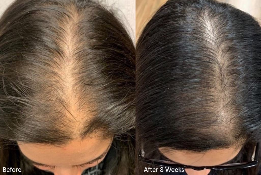 keralase non surgical hair restoration phoenix az before after ()