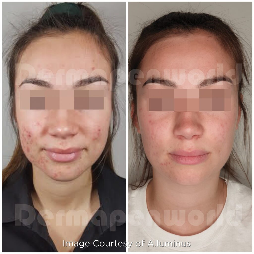Acne and Acne Scarring Female C