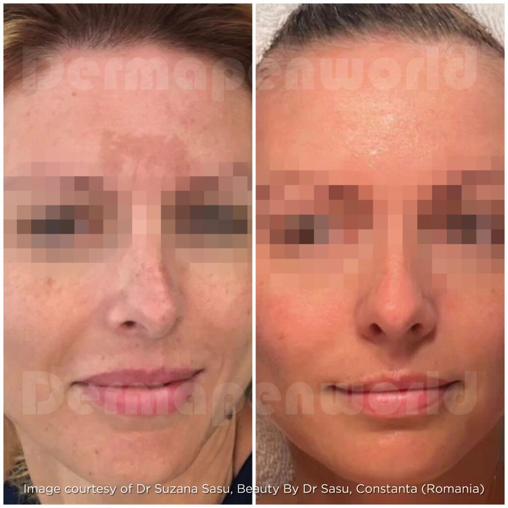 Pigmentation Female Exosomes