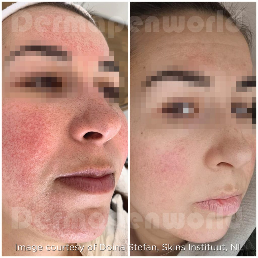 Rosacea Female Exosomes