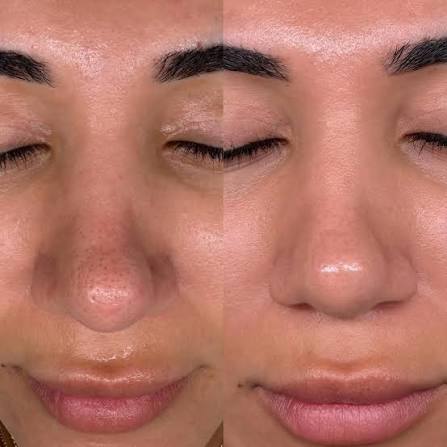 microneedling enlarged pores before after
