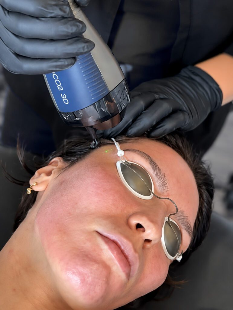 woman getting eco d skin resurfacing in phoenix az