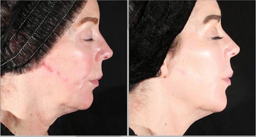LaseMD Ultra Brighten and Refine