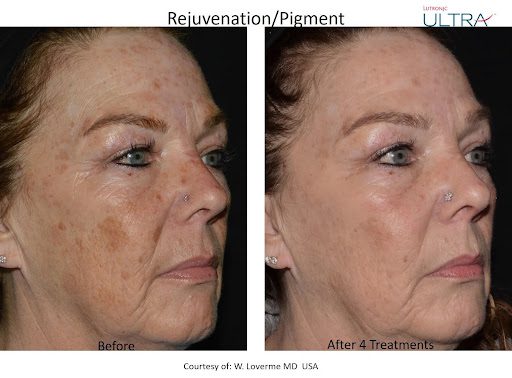XERF Before and After Treatment