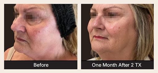 XERF Radiofrequency Skin Tightening