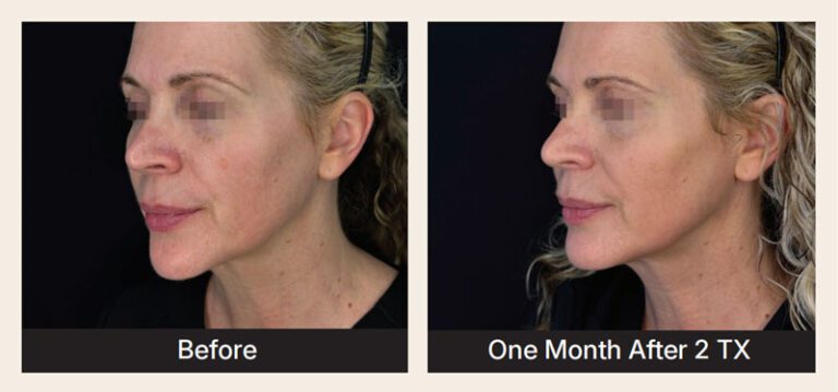 k luxe before after