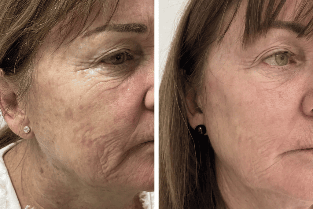 fractional CO2 laser treatment ahwatukee