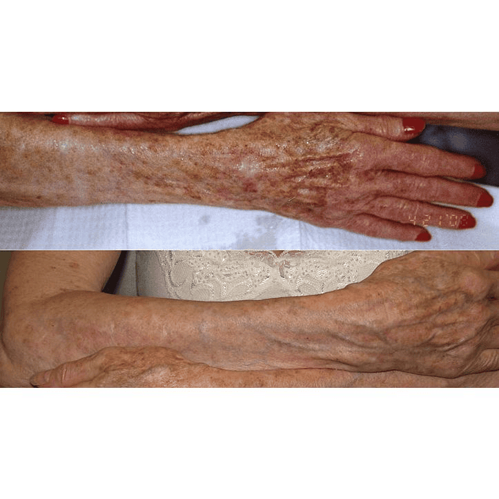 Sun Damage and Pigmentation
