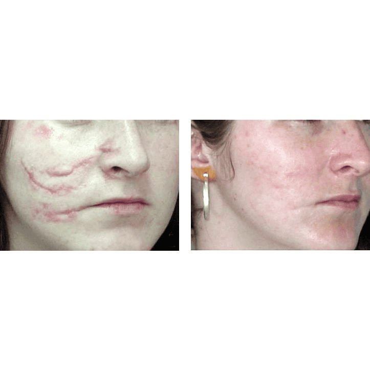 Traumatic Scars treatment